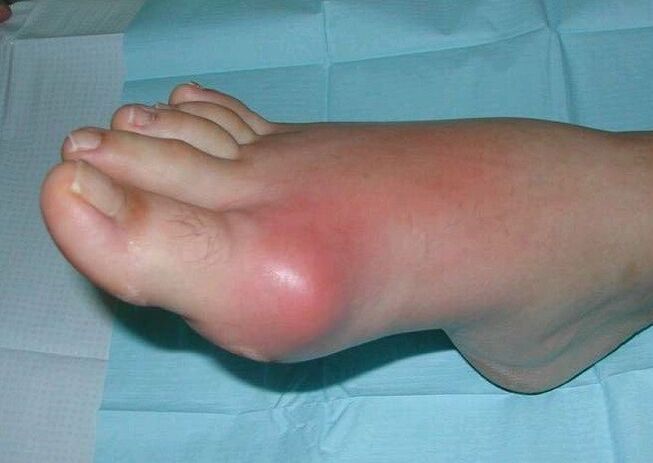 Clinical picture of foot arthritis - swelling and inflammation
