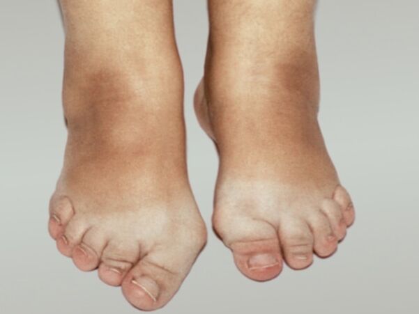 Osteoarthritis of the foot with severe toe deformity