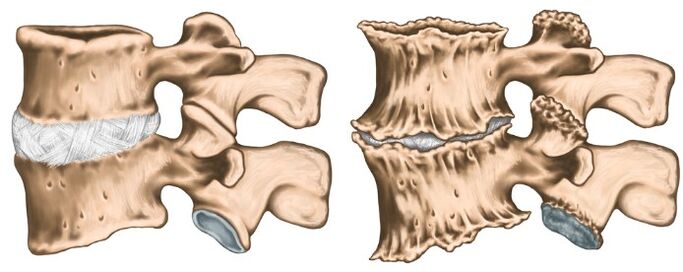 Healthy and destroyed joint