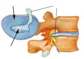 destruction of the annulus fibrosus in cervical osteochondrosis