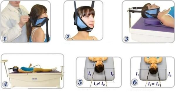 treatment of cervical osteochondrosis with traction