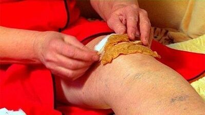 Compresses osteoarthritis of the knee joint