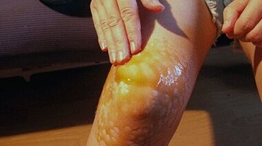Friction for the treatment of osteoarthritis of the knee joint