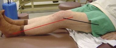 Progressive osteoarthritis of the knee joint