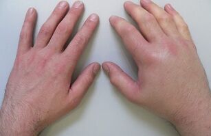 arthralgia as a cause of pain in the joints of the fingers
