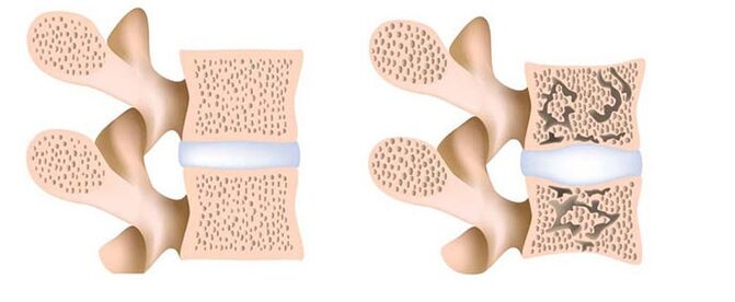 osteoporosis - removal of calcium from bones
