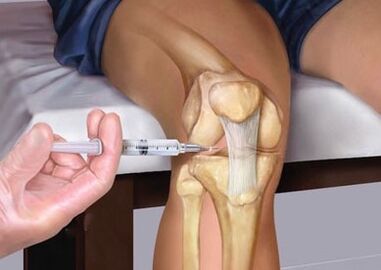 Injection into the joint