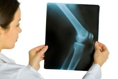 Treatment of osteoarthritis of knee joint
