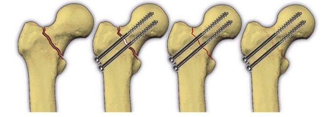 fixation of the bone body with pins for pain in the hip joint