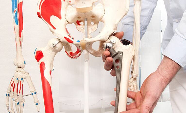 hip replacement for pain