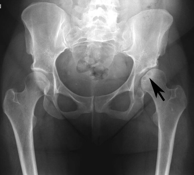 Deposition of calcium salts in the hip joint with X-ray pseudogout