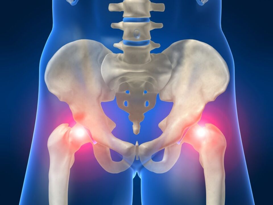 In ankylosing spondylitis, bilateral pain in the hip joint is bothersome